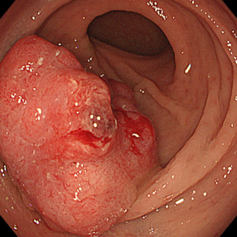 進行大腸癌