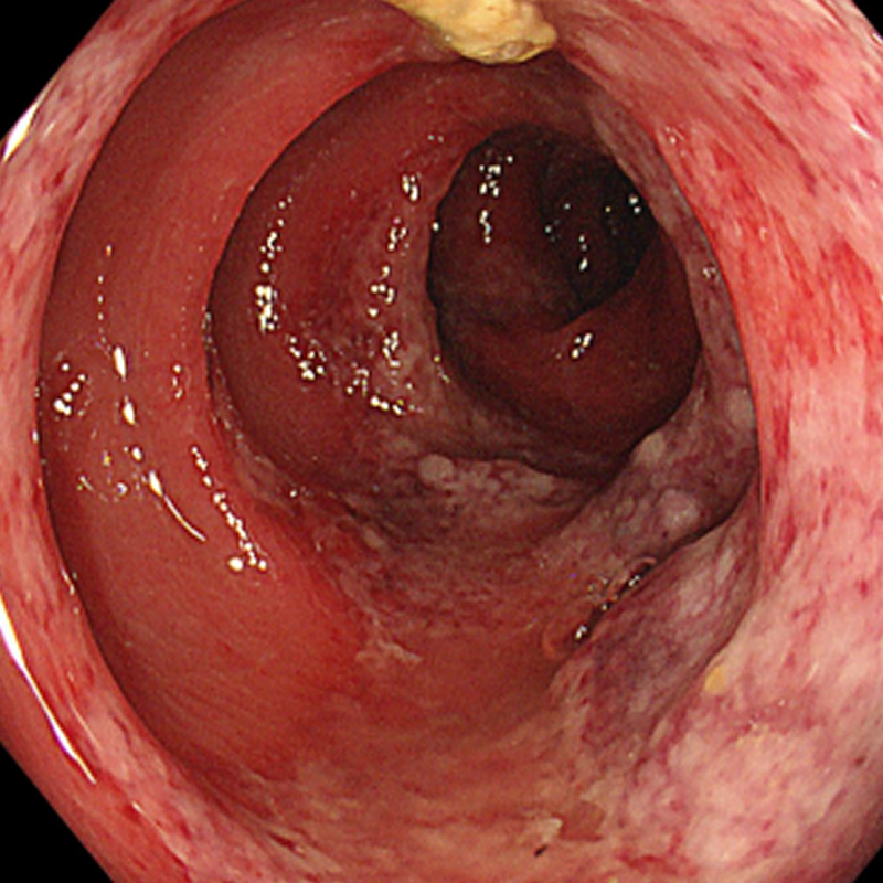 虚血性腸炎