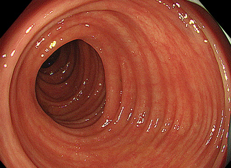 大腸カメラ検査